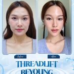 Bản sao của T3 PT43 Threadlift Beyoung 7(đã đăng)