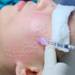 Tiem-Mesotherapy-la-gi